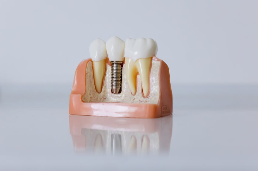 Jakie są największe korzyści implantów zębowych?